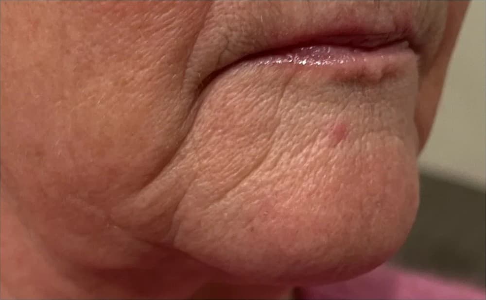 Området runt munnen före behandling