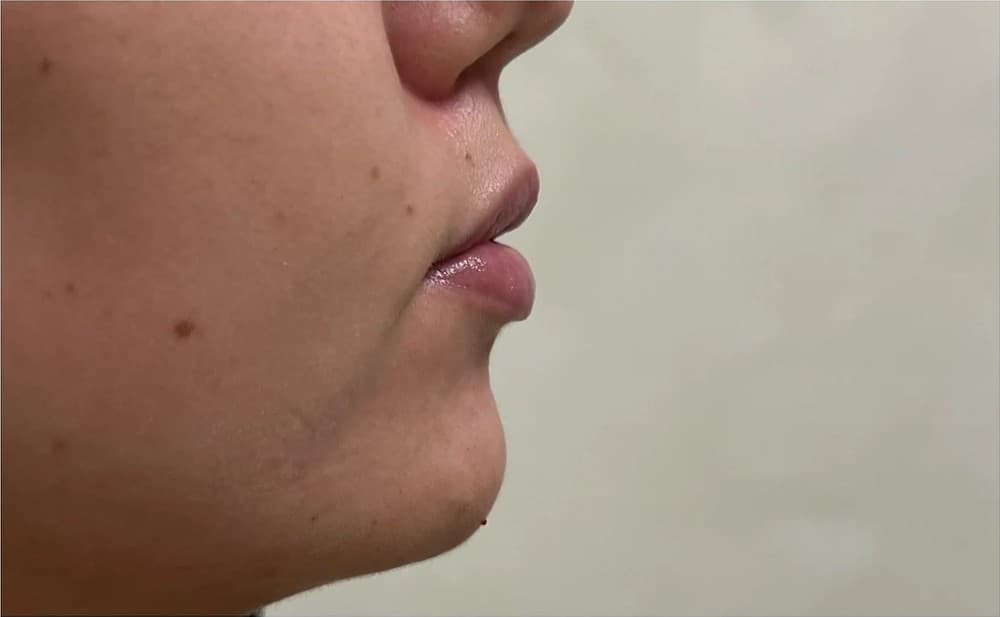 Haka och käklinje, sedd i profil efter behandling